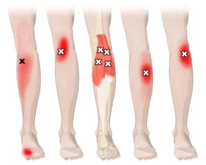 upper calf trigger point spots