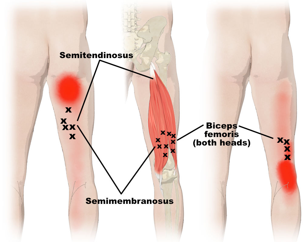 hamstring trigger point locations