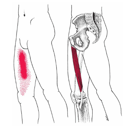 Adductor Longus trigger point pain location
