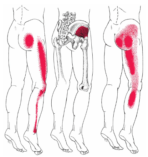 Gluteus Minimus Trigger Points